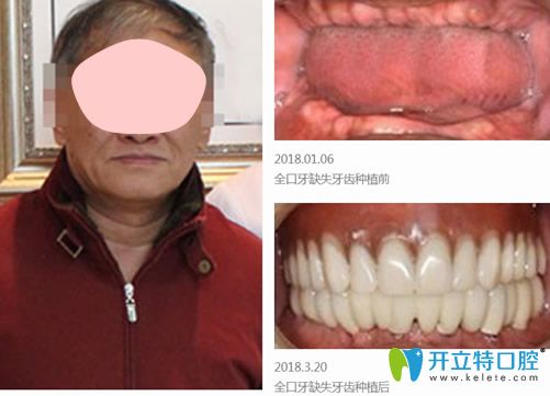 張宏山院長(zhǎng)采用功夫種植技術(shù)種植牙案例