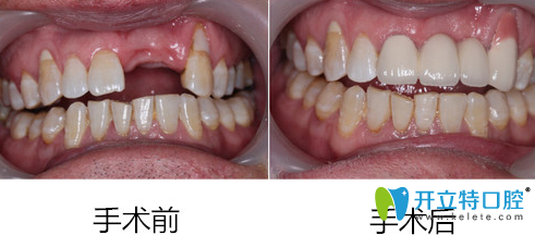深圳蒙恩齒科黃美華單顆種植牙前后效果對(duì)比圖
