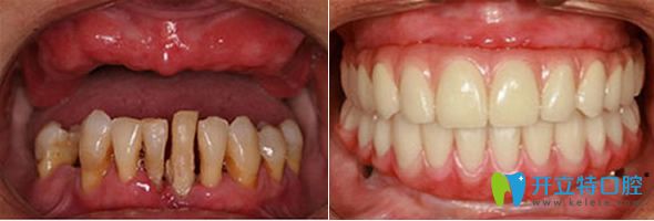 鄭州雅美口腔微創(chuàng)種植牙效果圖 鄭州雅美口腔微創(chuàng)種植牙效果圖