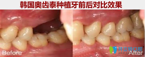韓國奧齒泰種植牙前后對比照片