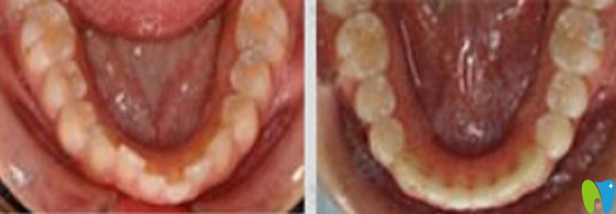 東莞拜博口腔譚碧川牙齒矯正案例 東莞拜博口腔譚碧川牙齒矯正案例