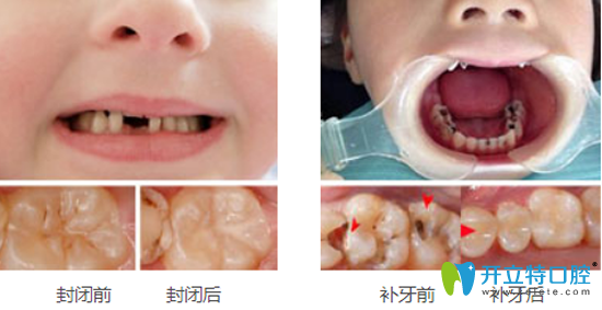 兒童在<!--<i data=20240703-sp></i>-->口腔治療前后效果對(duì)比照片