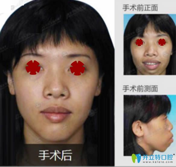 薛國初齙牙正頜手術前后對比案例