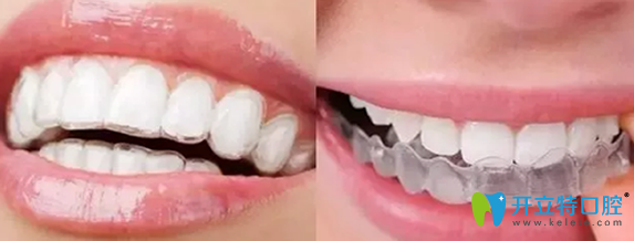 隱形矯正器的價格要多少?透明的牙套真的可以矯正牙齒嗎
