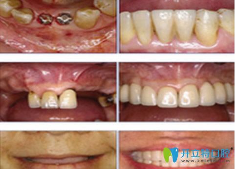 廣州瑞爾口腔牙齒種植效果案例