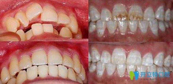 佛山粵冠牙科正畸美白案例對比圖