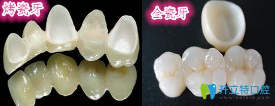 烤瓷牙和全瓷牙的區(qū)別在哪里