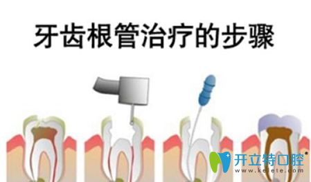 牙齒根管治療步驟和過程