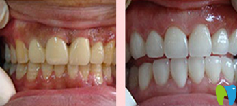 清遠(yuǎn)中大口腔洗牙前后效果對(duì)比圖