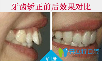 清遠(yuǎn)中大口腔牙齒矯正前后效果對(duì)比圖