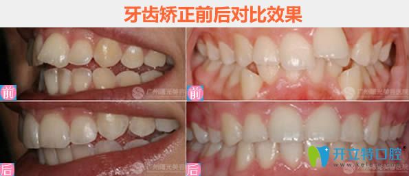 廣州曙光牙齒排列不齊及牙齒擁擠矯正對(duì)比圖