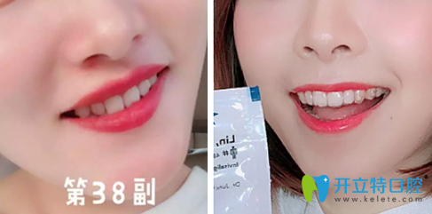 本人在德倫口腔做隱適美牙齒矯正一年的效果
