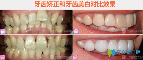 廣州曙光口腔李錦鴻牙齒擁擠及牙齒美白前后對(duì)比效果