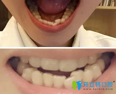 廣州拜博口腔怎么樣，28歲隱形牙齒矯正前后對(duì)比照片來揭曉