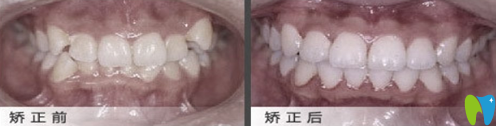 在北京佳美口腔做牙弓形態(tài)異常矯正案例治療效果對(duì)比