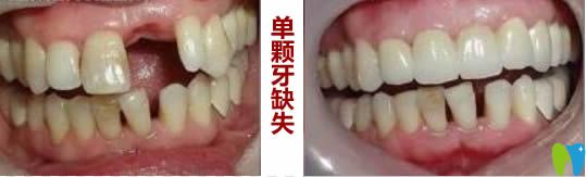 北京瑞泰口腔單顆牙科缺失種植前后對(duì)比效果
