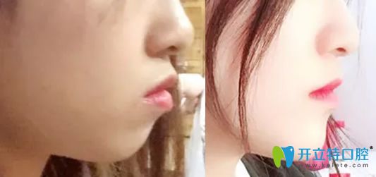 牙齒矯正能改變臉行嗎？看佳美口腔牙齒矯正前后對(duì)比照片知