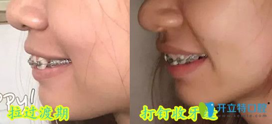 深圳弘和口腔齙牙齒矯正過(guò)渡期