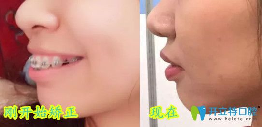 深圳弘和口腔齙牙前突矯正后對(duì)比照