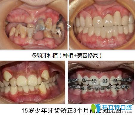 牙齒種植+青少年牙齒正畸案例前后對比照