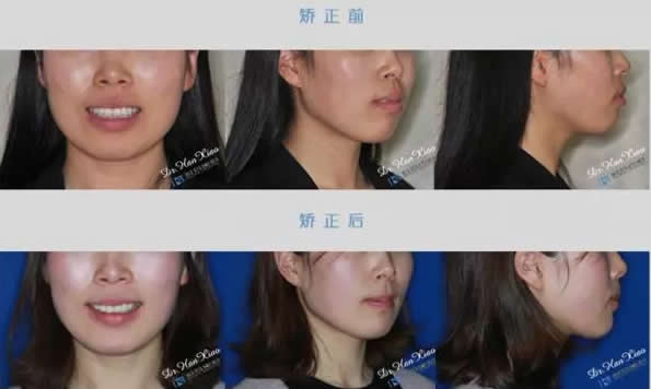 看26歲的小姜在上?？仆啐X科牙齒矯正案例 效果堪比整形哦