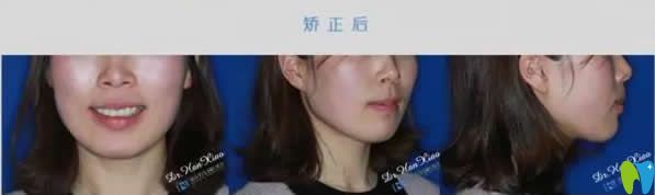 科瓦口腔隱形矯正牙齒18個月的效果