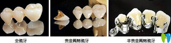 烤瓷牙的種類