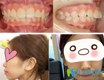 上海科美口腔怎么樣？看了我28歲牙齒矯正前后照片真是后悔