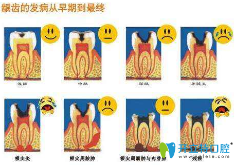 齲齒治療步驟圖