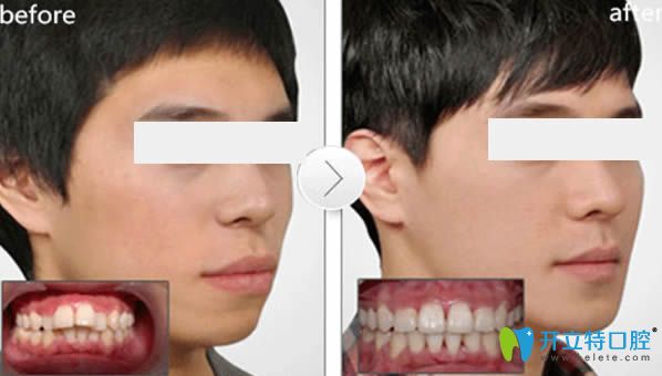 時代天使隱形牙齒矯正前后對比照