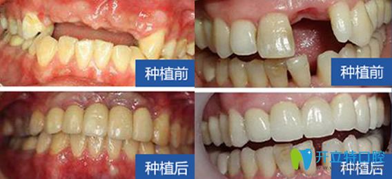西安雁塔惟真口腔怎么樣？百萬(wàn)真實(shí)案例，彰顯種植優(yōu)勢(shì)