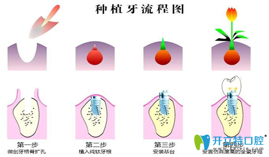 種植牙步驟圖