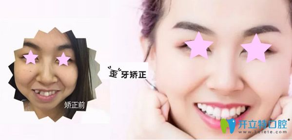 太原眾牙口腔牙齒正畸效果案例