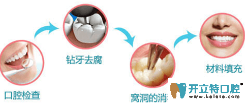 揭秘：光固化樹脂補牙詳細步驟和補牙注意事項大全