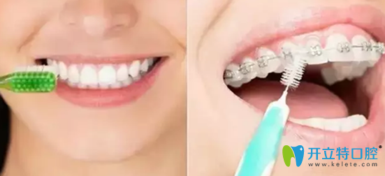 傳統(tǒng)牙套和隱形矯正清潔難易程度對(duì)比