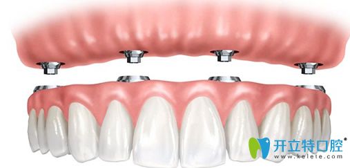 永康口腔黃世宇院長(zhǎng)為王大媽設(shè)計(jì)的診療方案 永康口腔黃世宇院長(zhǎng)為王大媽設(shè)計(jì)的診療方案