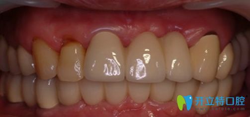 黃院長(zhǎng)“即可用”種植術(shù)后效果圖 黃院長(zhǎng)“即可用”種植術(shù)后效果圖