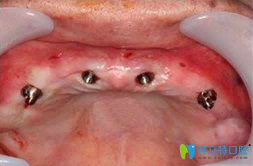 北京永康口腔多顆牙缺失種植效果圖 北京永康口腔多顆牙缺失種植效果圖