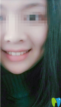 康圓口腔做的成人牙齒矯正 給大家看看正畸前后對比圖片