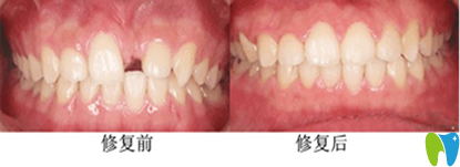 <!--<i data=20240703-sp></i>-->華門牙缺失即刻種植案例