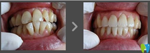 沈真祥醫(yī)生矯正牙齒效果案例