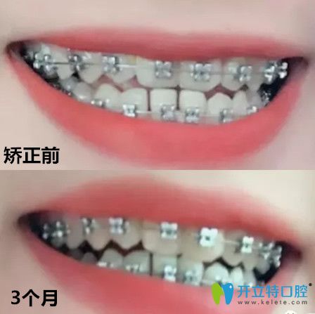 拜博口腔地包天矯正前后牙齒變化對比圖