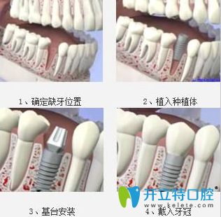 種植牙有沒有副作用