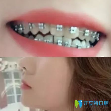 在杭州拜博口腔做地包天矯正3個月牙齒圖片
