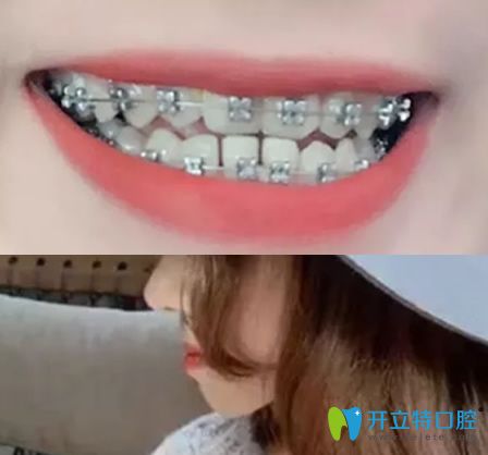 杭州拜博口腔“地包天”矯正戴鋼牙套第1天