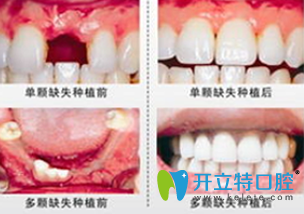 鄭州精益口腔李瑞萍院長種植牙前后對比圖