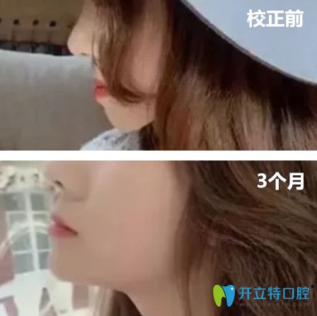 去杭州拜博口腔做地包天矯正前后臉型變化圖展示