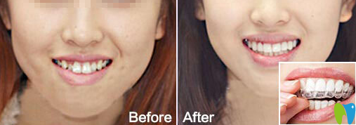 鄭州精益口腔李曉瑞牙齒矯正前后效果對(duì)比圖 鄭州精益口腔李曉瑞牙齒矯正前后效果對(duì)比圖