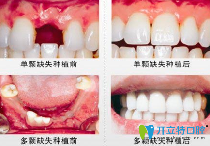 杭州科瓦齒科種植牙前后效果對比圖