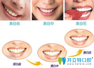 皓齒美白牙齒多少錢？解析步驟及優(yōu)缺點(diǎn)